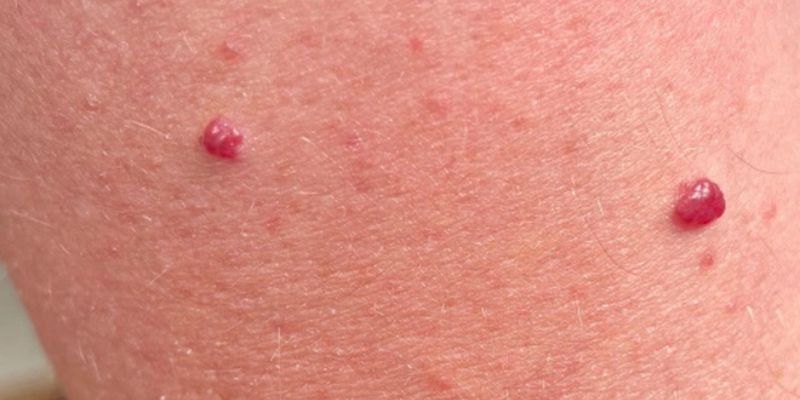 Ý Nghĩa Nốt Ruồi Son – Giải Mã Tài Lộc và Vận Mệnh tại SHBET 3 Chọn số may mắn từ nốt ruồi son